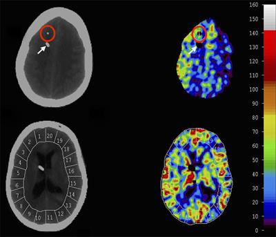 The Correlation between Cerebral Blood Flow Measured by Bedside Xenon-CT and Brain Chemistry Monitored by Microdialysis in the Acute Phase following Subarachnoid Hemorrhage